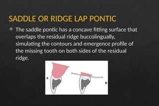 Pontics in fixed partial denture prosthodontics | PPTX
