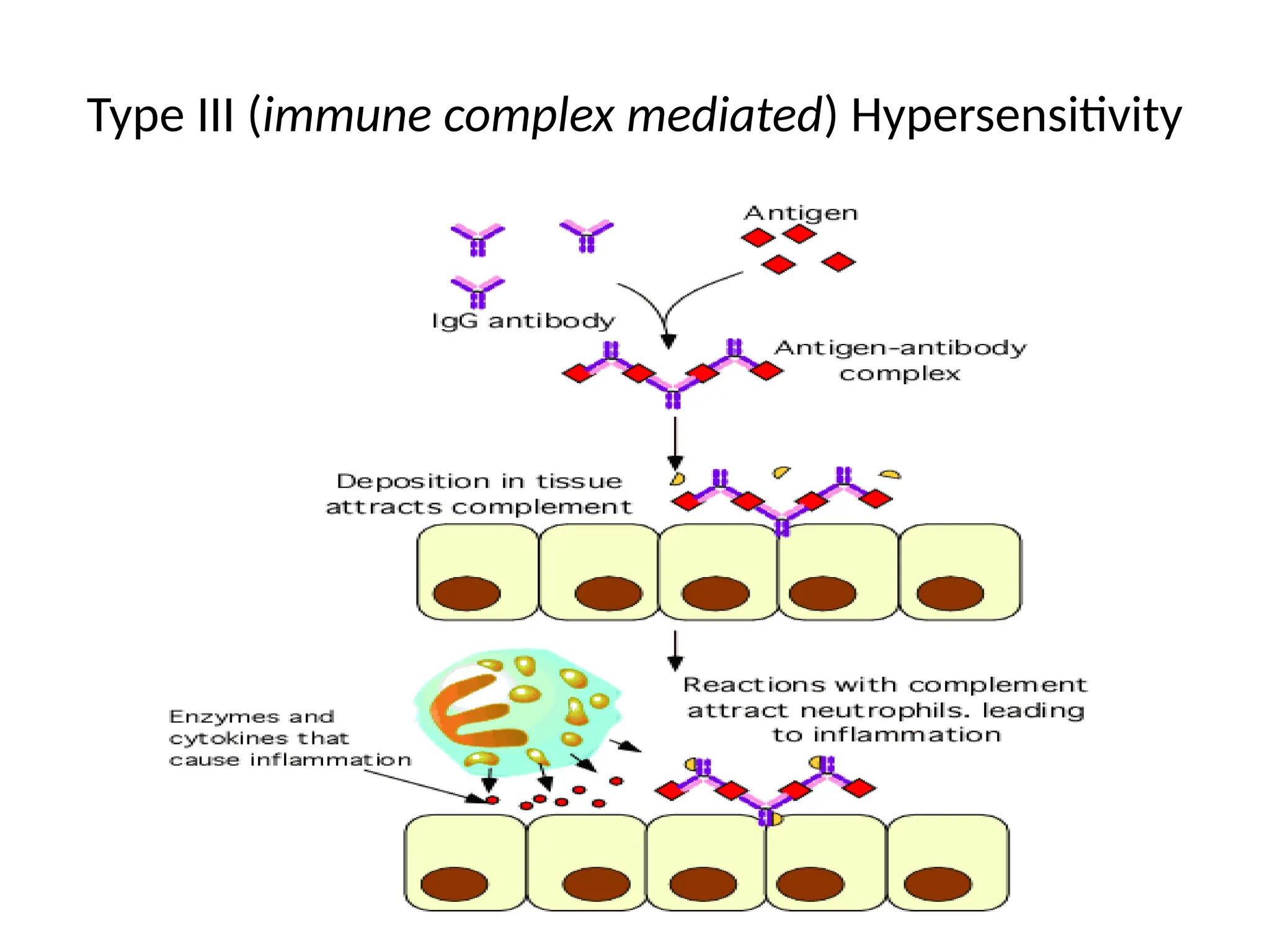Type III (immune complex mediated) Hypersensitivity
 