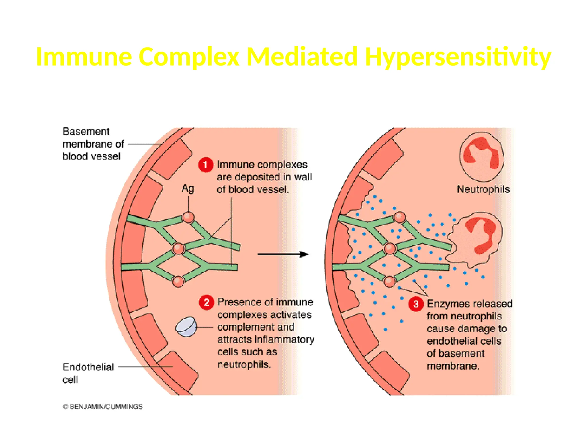 Immune Complex Mediated Hypersensitivity
 