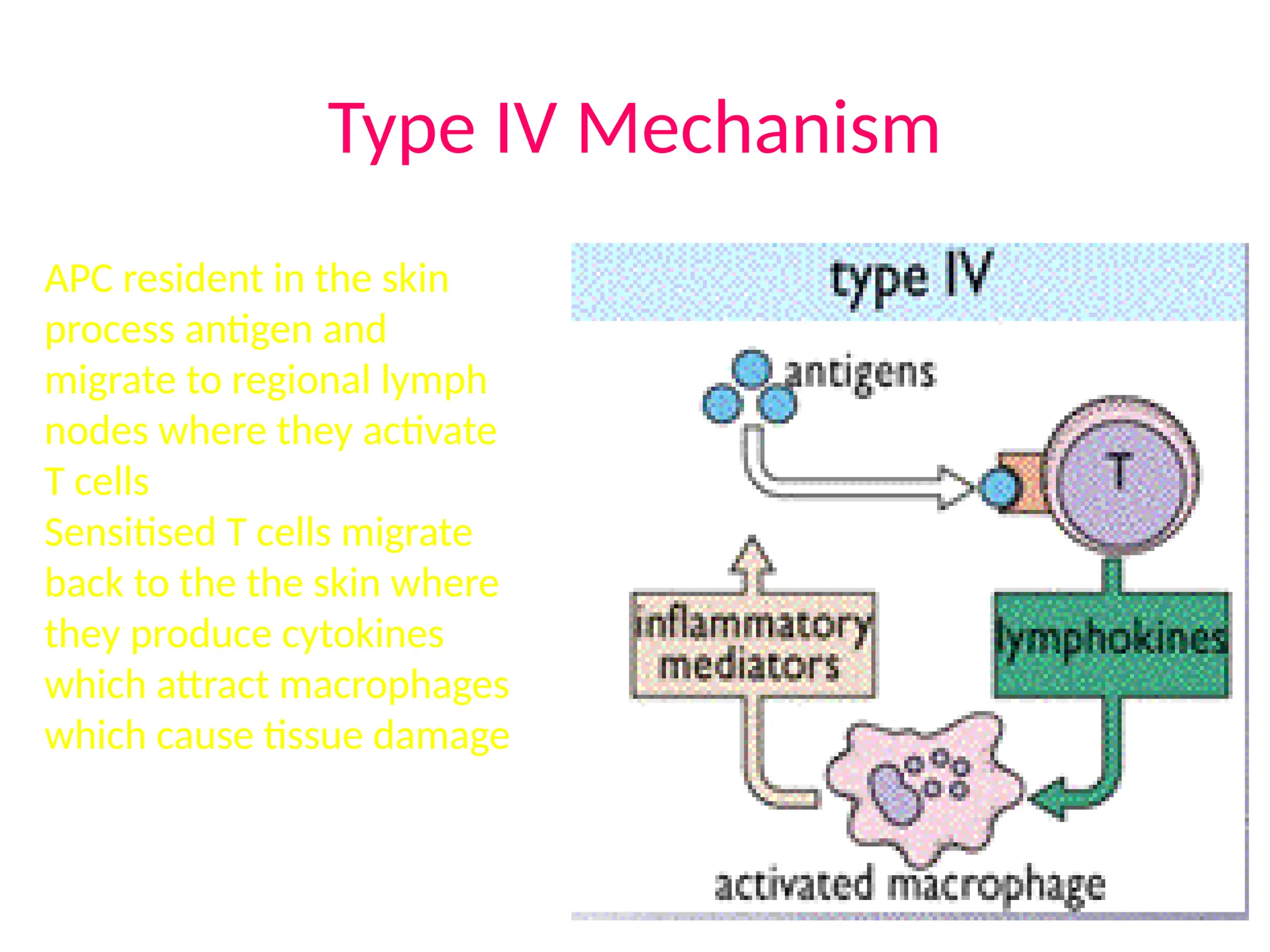 Type IV Mechanism
APC resident in the skin
process antigen and
migrate to regional lymph
nodes where they activate
T cells
Sensitised T cells migrate
back to the the skin where
they produce cytokines
which attract macrophages
which cause tissue damage
 