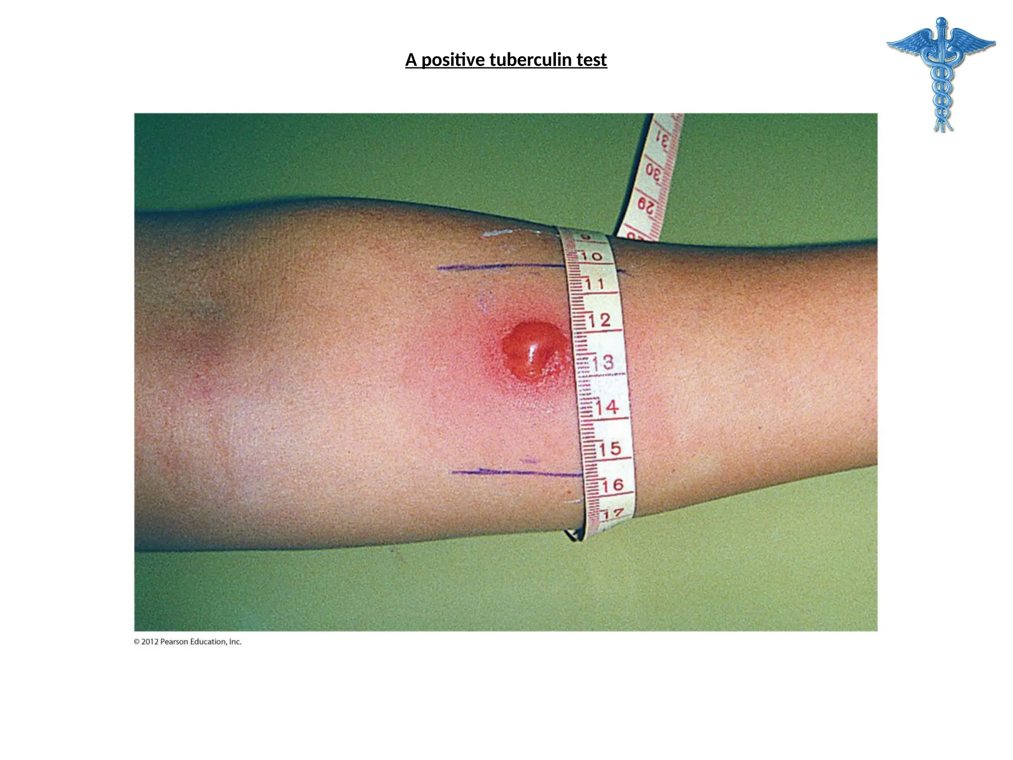A positive tuberculin test
 