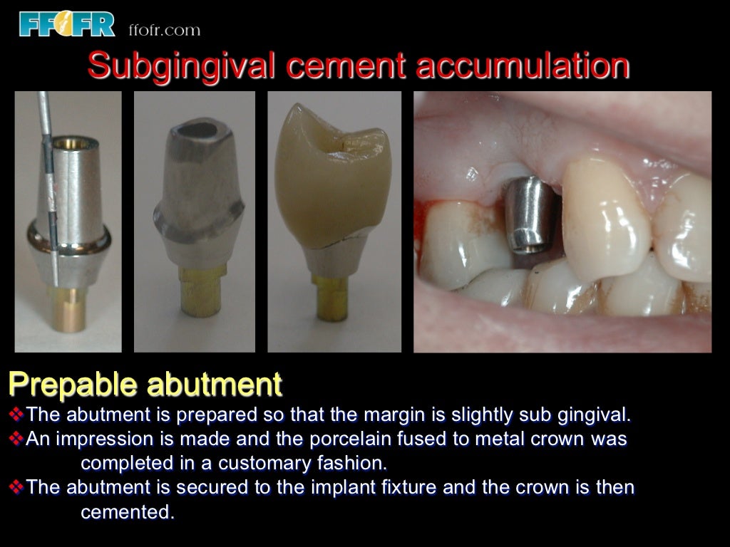 Abutment Selection