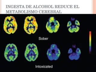 INGESTA DE ALCOHOL REDUCE EL METABOLISMO CEREBRAL 