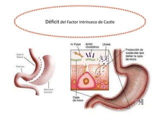 Déficit del Factor Intrínseco de Castle
 