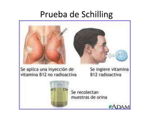 Prueba de Schilling
 