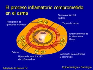 El proceso inflamatorio comprometido en el asma Epidemiología / Patología Adaptado de Barnes PJ Edema Descamación del  epitelio Tapón de moco Engrosamiento de  la Membrana Basal Infiltración de neutrófilos y   eosinófilos Hipertrofia y contracción  del músculo liso  Hiperplasia de  glándulas mucosas 