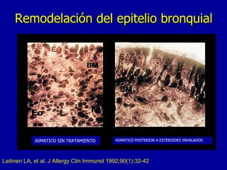 Remodelación del epitelio bronquial Laitinen LA, et al. J Allergy Clin Immunol 1992;90(1):32-42 ASMATICO SIN TRATAMIENTO ASMATICO POSTERIOR A ESTEROIDES INHALADOS Asmático Asmático tratado con esteroides 