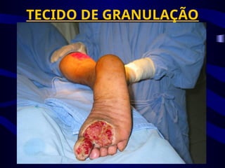 TECIDO DE GRANULAÇÃO
 