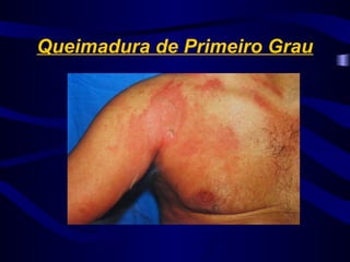 Queimadura de Primeiro Grau
 