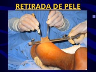RETIRADA DE PELE
 