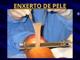 ENXERTO DE PELE
 