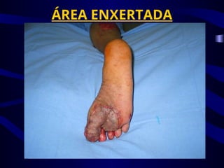 ÁREA ENXERTADA
 