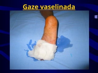 Gaze vaselinada
 
