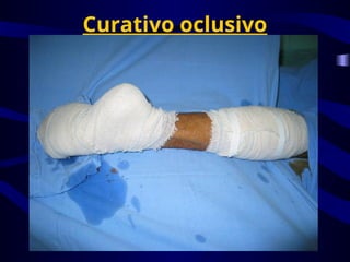 Curativo oclusivo
 