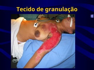 Tecido de granulação
 