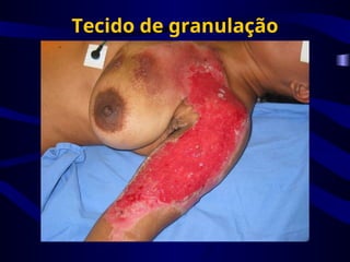 Tecido de granulação
 