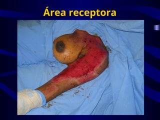 Área receptora
 