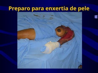 Preparo para enxertia de pele
 