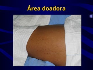 Área doadora
 