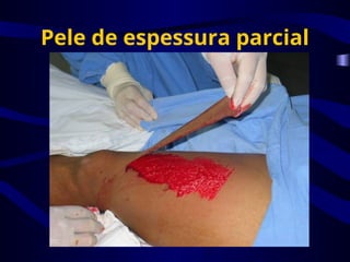 Pele de espessura parcial
 