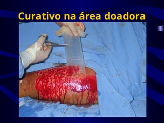Curativo na área doadora
 