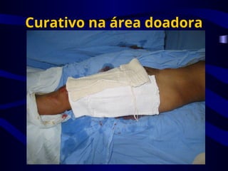 Curativo na área doadora
 