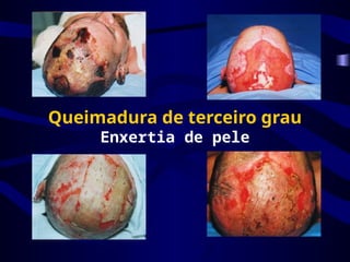 Queimadura de terceiro grau
Enxertia de pele
 