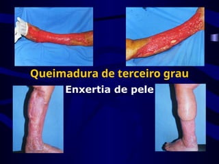 Queimadura de terceiro grau
Enxertia de pele
 
