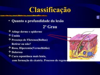 Classificação
• Quanto a profundidade da lesão
2º Grau
 Atinge derme e epiderme
 Úmida
 Presença de Flictenas(Bolhas)
Retirar ou não?
 Rosa, Hiperemia(Vermelhidão)
 Dolorosa
 Cura espontânea mais lenta,
com formação de cicatriz. Processo de regeneração
 