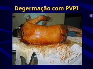 Degermação com PVPI
 