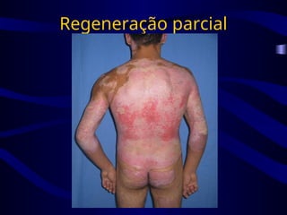 Regeneração parcial
 