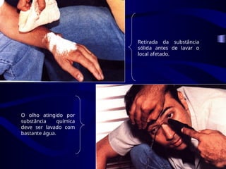 O olho atingido por
substância química
deve ser lavado com
bastante água.
Retirada da substância
sólida antes de lavar o
local afetado.
 