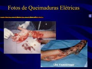Fotos de Queimaduras Elétricas
 