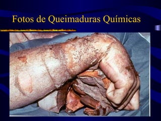 Fotos de Queimaduras Químicas
 