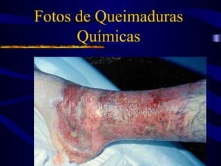 Fotos de Queimaduras
Químicas
 