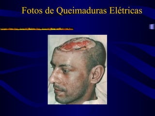 Fotos de Queimaduras Elétricas
 