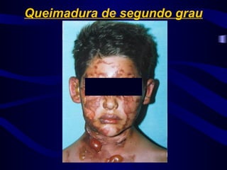 Queimadura de segundo grau
 