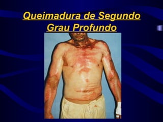 Queimadura de Segundo
Grau Profundo
 