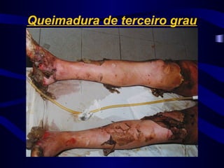Queimadura de terceiro grau
 
