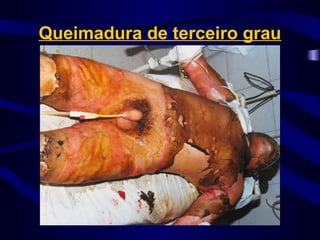 Queimadura de terceiro grau
 