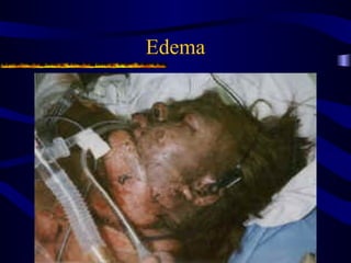 Edema
 