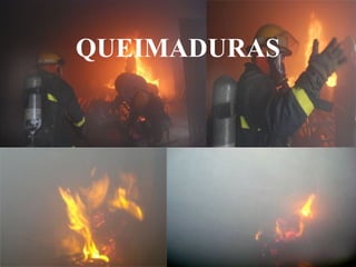 QUEIMADURAS
 
