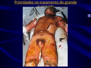 Prioridades no tratamento do grande
queimado
 