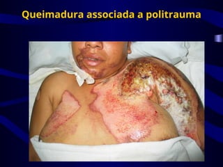 Queimadura associada a politrauma
 