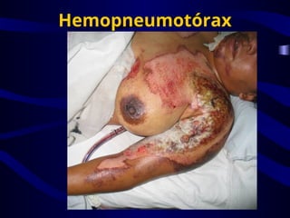 Hemopneumotórax
 