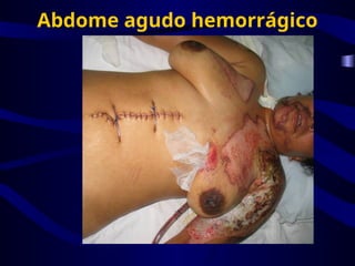 Abdome agudo hemorrágico
 