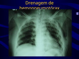 Drenagem de
hemopneumotórax
 