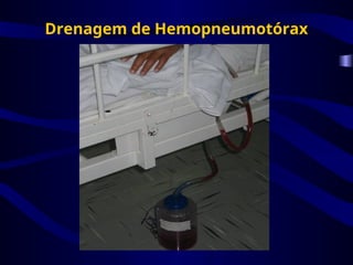 Drenagem de Hemopneumotórax
 