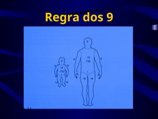 Regra dos 9
 