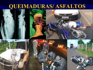 QUEIMADURAS/ ASFALTOS
 